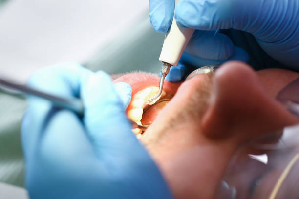 Best Urgent Care for Lost Fillings or Crowns in South Park, WY